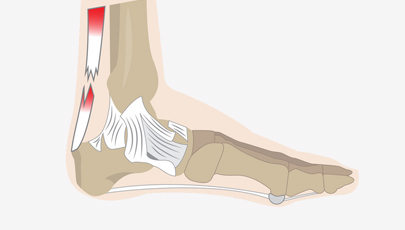 跟腱断裂